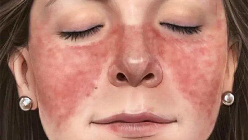 Lupus ban đỏ có thể xuất hiện triệu chứng đau nhức toàn thân