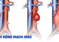 Phát hiện túi phình mạch máu từ cơn chóng mặt