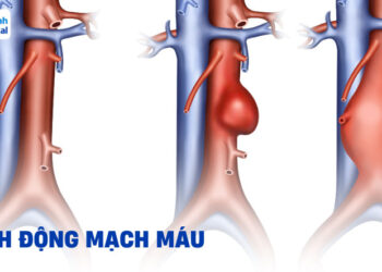 Phát hiện túi phình mạch máu từ cơn chóng mặt