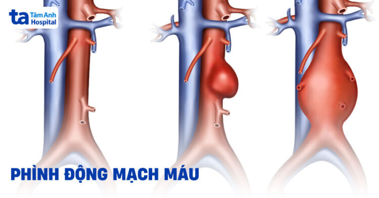 Phát hiện túi phình mạch máu từ cơn chóng mặt
